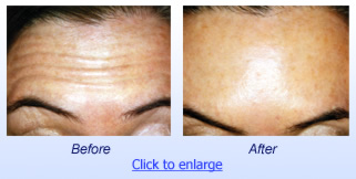 Botox Costmetic Before & After 1