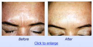Botox Cosmetic Before & After 2