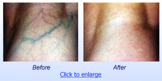 ELVeS Vein Treatment Before & After 1