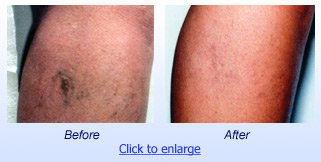 ELVeS Vein Treatment Before & After 1