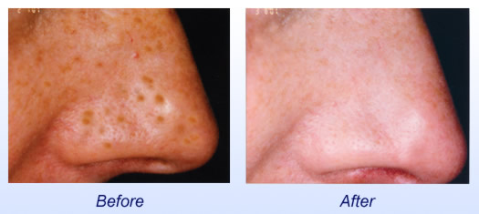 PhotoFacial Before & After 3