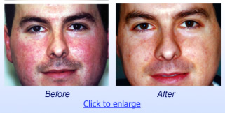 PhotoFacial Before & After