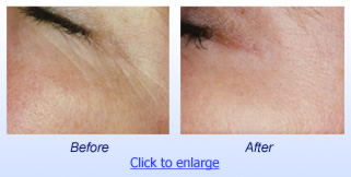 PhotoFacial Before & After