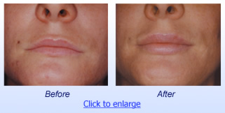 Restylane Before & After 1