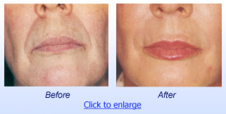 Restylane Before & After