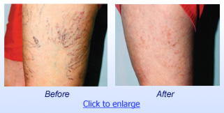 Sclerotherapy Before & After 1