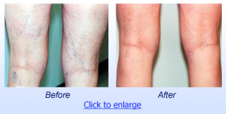 Sclerotherapy Before & After 2