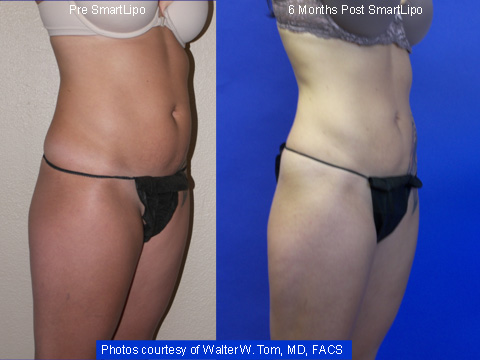 SmartLipo Before & After