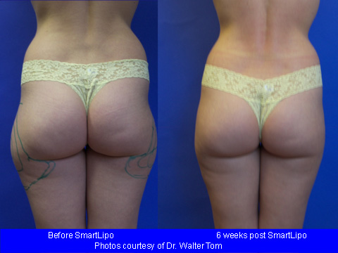 SmartLipo Before & After